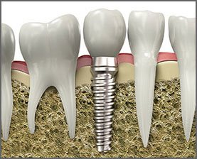 Dental-Implant