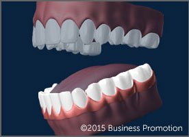 Denture