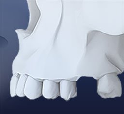 GraftMaterialAndImplantPlaced