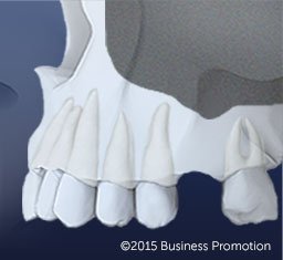 InadequateBone2